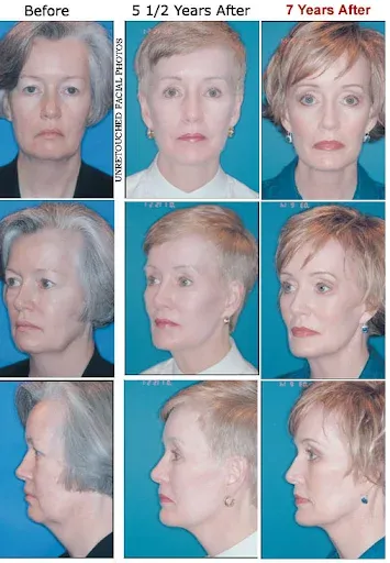 Plastic Surgeon Columbus - T. William Evans DDS MD FACS 4 Featured image