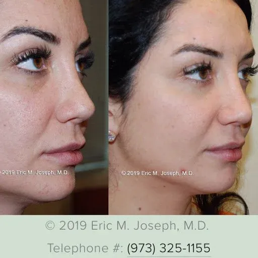 Plastic Surgeon Livingston - Eric M. Joseph MD - Rhinoplasty Specialist 4 Featured image