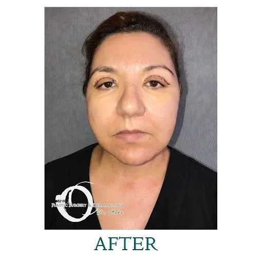 Plastic Surgeon Los Angeles - Plastic Surgery Center of Beverly Hills 6 Featured image