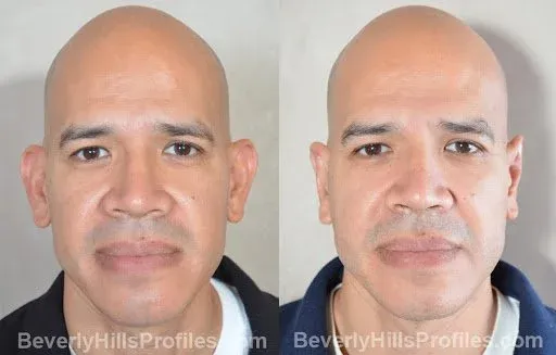 Plastic Surgeon Los Angeles - Profiles Beverly Hills 2 Featured image